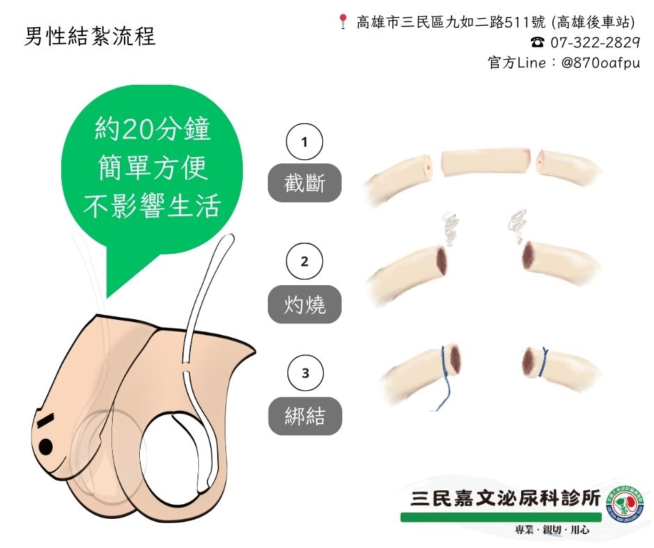 無痛舒眠結紮、包皮、菜花手術 [九如三民分院]的第2張圖片