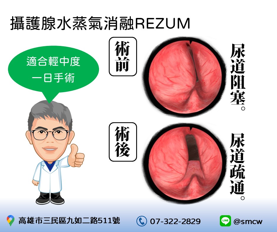 攝護腺水蒸氣消融術[三民分院]的第2張圖片