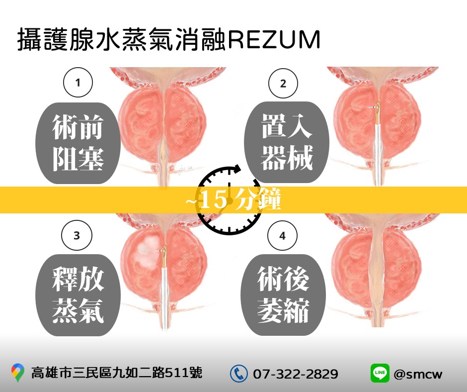 攝護腺水蒸氣消融術[三民分院]的第3張圖片